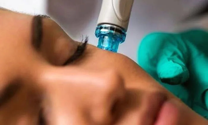 microneedling-sessions