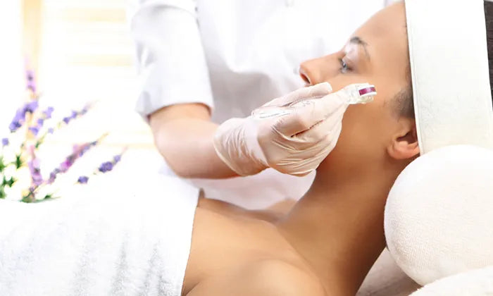 1-3-or-5-x-microneedling-sessions