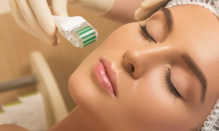 1-3-or-5-x-microneedling-sessions